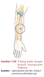 Tulang_pada_lengan_mengalami_fraktura.webp